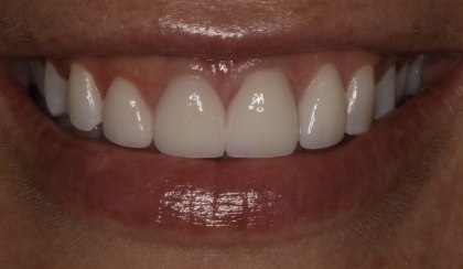 Closeup of young woman's flawless smile after porcelain veneers