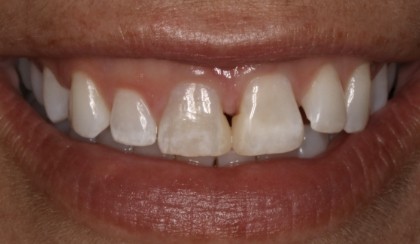 Closeup of young woman's imperfect smile before porcelain veneers