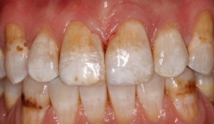 Closeup of young woman's flawless smile after porcelain veneers