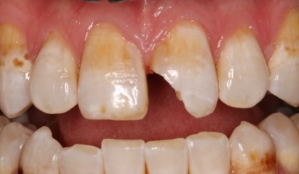 Closeup of young woman's imperfect smile before porcelain veneers