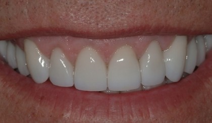 Closeup of young woman's flawless smile after porcelain veneers