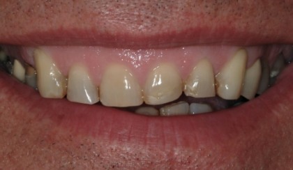 Closeup of young woman's imperfect smile before porcelain veneers