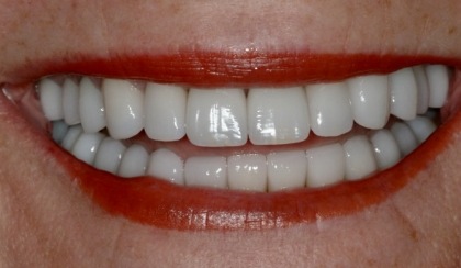 Closeup of young woman's flawless smile after porcelain veneers