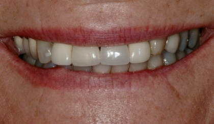 Closeup of young woman's imperfect smile before porcelain veneers