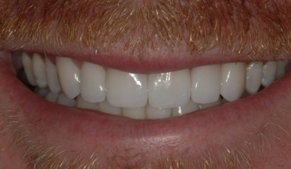 Closeup of young woman's flawless smile after porcelain veneers