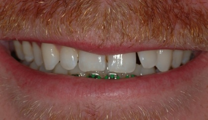 Closeup of young woman's imperfect smile before porcelain veneers