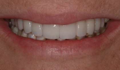 Closeup of young woman's flawless smile after porcelain veneers