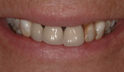 Closeup of young woman's imperfect smile before porcelain veneers