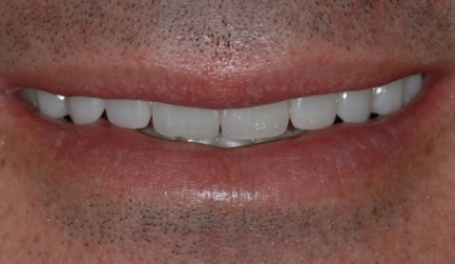 Closeup of young woman's flawless smile after porcelain veneers