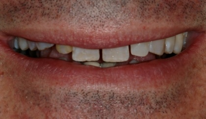 Closeup of young woman's imperfect smile before porcelain veneers