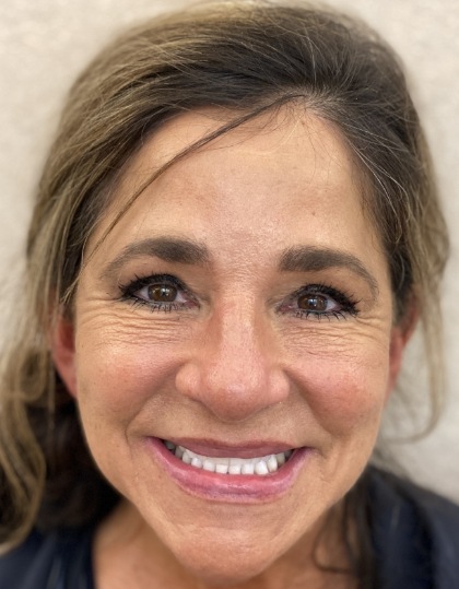 Woman with discolored dental bonding and imperfect smile