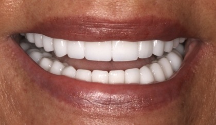 Closeup of woman's flawless smile after porcelain veneer treatment