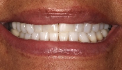 Closeup of woman's discolored dental bonding and imperfect smile