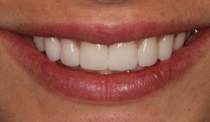 Closeup of woman's flawless smile after porcelain veneer treatment