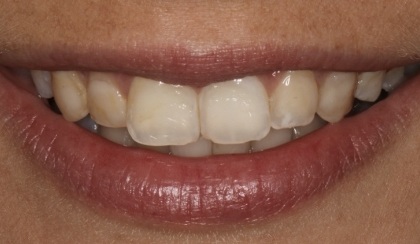 Closeup of woman's discolored dental bonding and imperfect smile