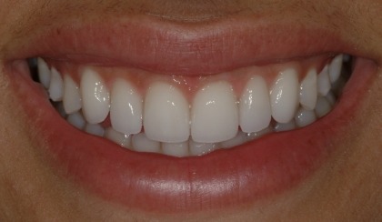 Closeup of woman's flawless smile after porcelain veneer treatment