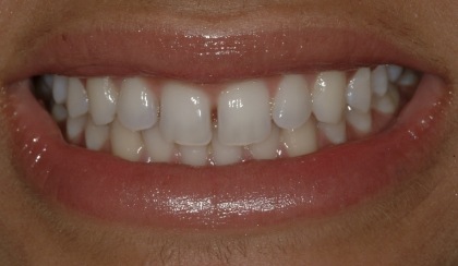 Closeup of woman's discolored dental bonding and imperfect smile